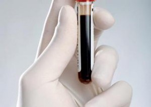 Krevní testy - jeden z nejrychlejších metod jak včas odhalit nedostatek železa